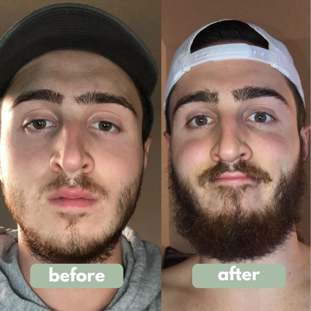 BeardPrime™ – Bartwuchsserum