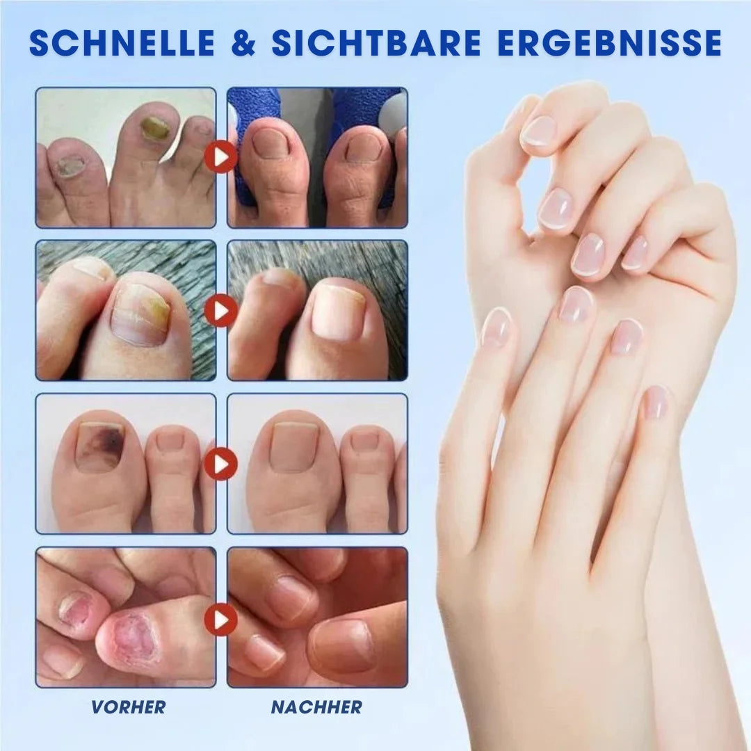 FUNGEX™ – Nagelpflaster gegen Nagelpilz